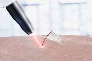 laser hair removal